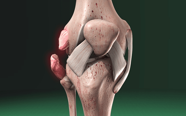 Lesiones de ligamentos (esguinces)