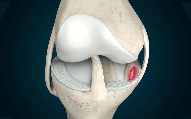 Lesiones meniscales