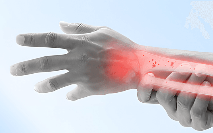 Osteoporosis con fracturas por fragilidad