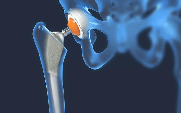 Cirugía ortopédica de cadera y rodilla